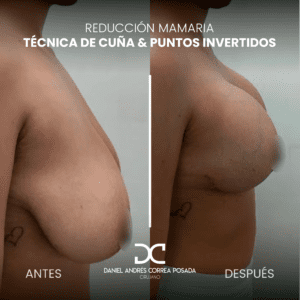 MASTOPEXIA