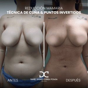 AYD REDUCCIÓN1