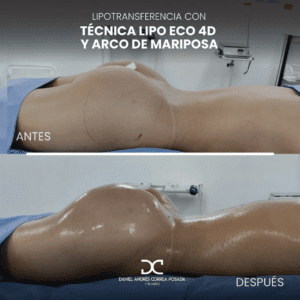 LIPOTRANSFERENCIA-51
