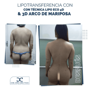 LIPOTRANSFERENCIA-52