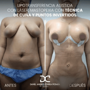 LIPOTRANSFERENCIA-53