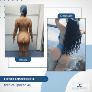 LIPOTRANSFERENCIA-54