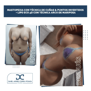 LIPOTRANSFERENCIA-55