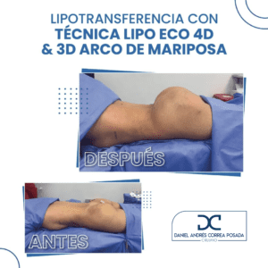 LIPOTRANSFERENCIA-56